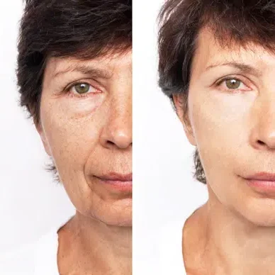 before and after left to right of woman HGH face results.png e1736853384778